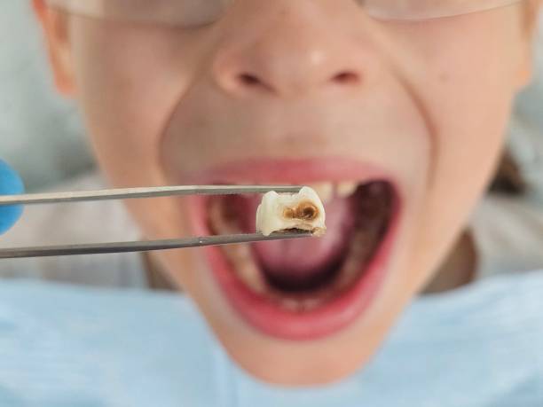 Best Broken or Cracked Tooth Emergency Dentist in South Congaree, SC